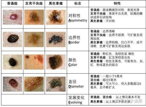 身體長黑痣|是痣還是瘤？黑色素瘤的類型、症狀與治療